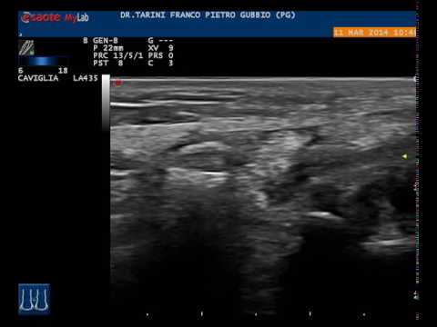 Dolori di spalla notte congiunta Stabilizzazione dellarticolazione del ginocchio per TPLO