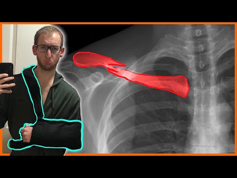 BROKE MY COLLARBONE SKATING