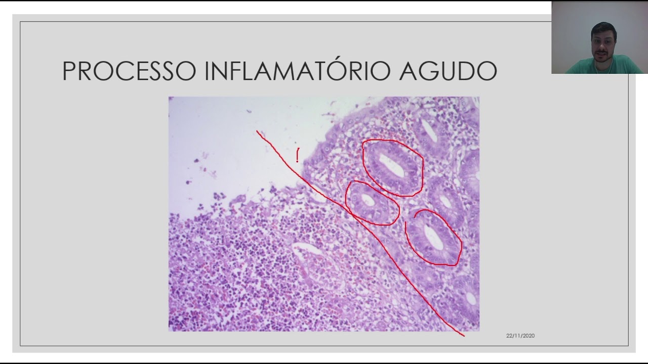Aula prática de Inflamação aguda
