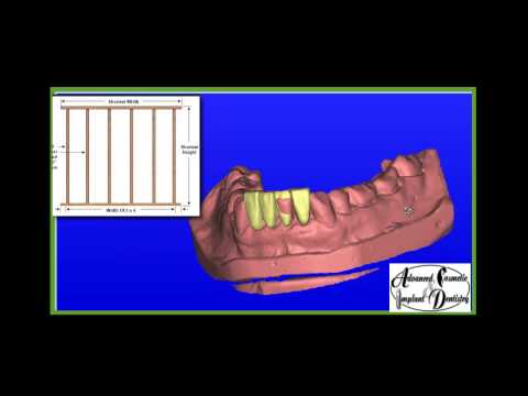 3D Computer Guided Implant Surgery