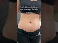 The Safest Stretch Mark Treatment ️