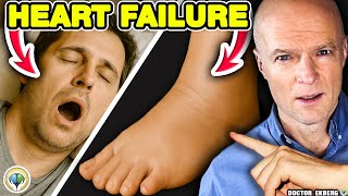 10 Signs Of Heart Failure That You Miss Daily