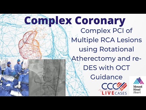 Complex PCI of Multiple RCA Lesions using Rotational Atherectomy and re-DES with OCT Guidance