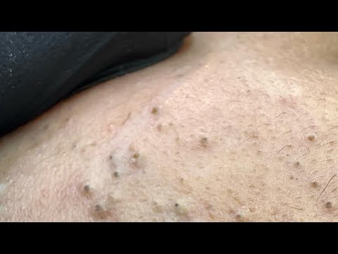 Die ultimative Gesichtspflege-Routine | Mitesserentfernung & Pickelbehandlung