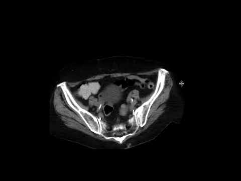Low-Grade Appendiceal Mucinous Neoplasm