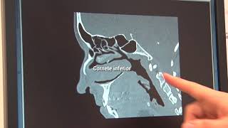Cirugía de rinosinusitis crónica