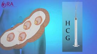 Inseminación artificial