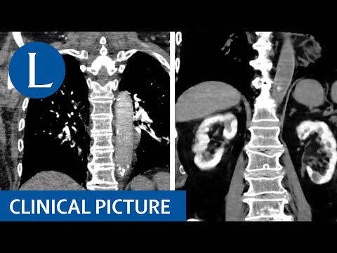 Contrast-associated acute kidney injury