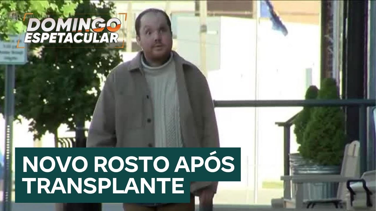 Jovem americano faz transplante raro e ganha novo rosto