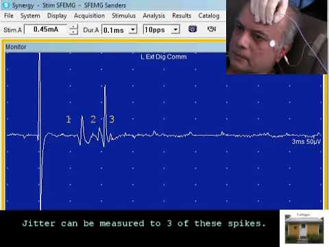 SFEMG - Stimulation Frontalis Needle  (Don Sanders)