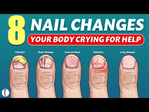 Nail signs of Disease | Nail pitting | Finger clubbing | Signs of anemia | Terry's nails