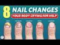 Nail signs of Disease | Nail pitting | Finger clubbing | Signs of anemia | Terry's nails