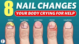 Nail signs of Disease | Nail pitting | Finger clubbing | Signs of anemia | Terry