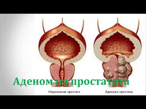Anzeichen von Prostata cr Prostata in Ungarn