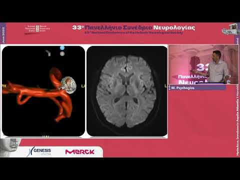 Psychogios M. - Up-to-date endovascular treatment of cerebral aneurysms and malformations 