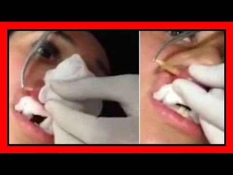 Barbabietola da vermi per bambini Come definire se se ha vermi