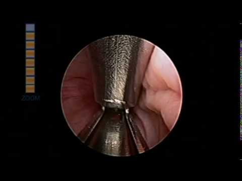 Die Auswirkungen von Prostata-Zyste Rektal Laser-Behandlung von Prostatitis