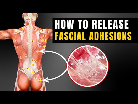 Fascial Adhesions Explained: What They Are, Why They Hurt, and How to Release Them