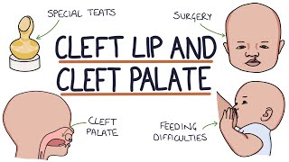 Cleft Lip and Cleft Palate For Students