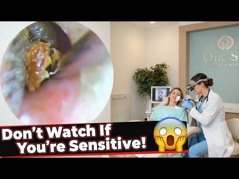 "Real Ear Wax Removal That Will Blow Your Mind!"