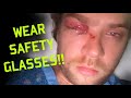 DID I JUST LOSE MY EYE?!?!! WEAR YOUR SAFETY GLASSES [My Story]