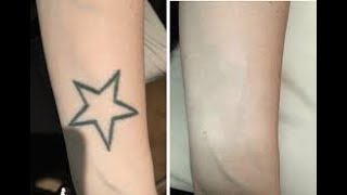 Fastest Way To Remove Temporary Tattoos