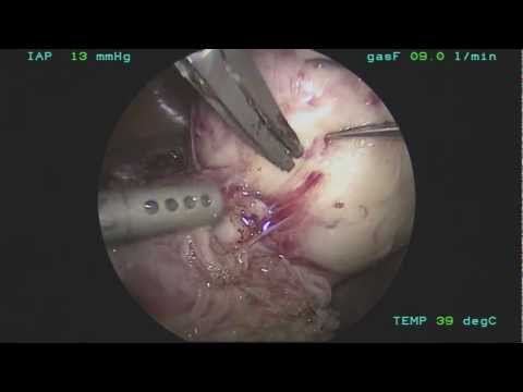 Laparoscopic Myomectomy