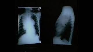 Radiology Mediast masses