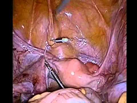 EndoGrabs for Uterus Retraction During Sigmoidectomy