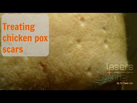 Iyon ay, upang mawalan ng timbang carbohydrates o protina Compresses para sa nasusunog taba sa tiyan