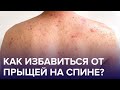 Из-за чего появляются ПРЫЩИ на спине? Как от них избавиться? | Доктор 24