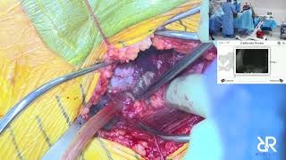 Dr. Stefan Kreuzer performs Total Hip Arthroplasty using Corin OPS w:TriFit CF