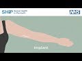 Having A Contraceptive Implant Fitted