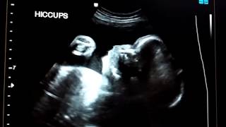 Hiccups in the womb.