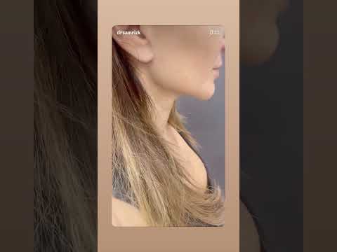 Deep Plane Facelift & Neck Lift: 1.5-Year Results | Dr. Rizk