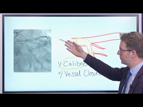 DK Crush for distal LM bifurcation: pearls and pitfalls - Webinar
