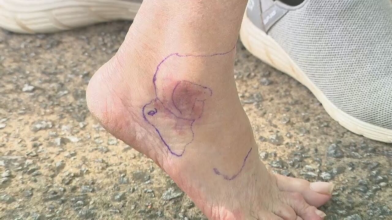 Video thumbnail for Woman bitten on foot by venomous copperhead: ‘I’ve never felt pain like that’ | WSB-TV