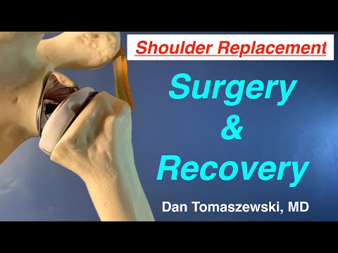 Shoulder Replacement, surgery and recovery