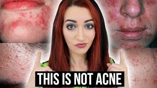 5 Things You THINK Are Acne - BUT ARE NOT! || Jess Bunty
