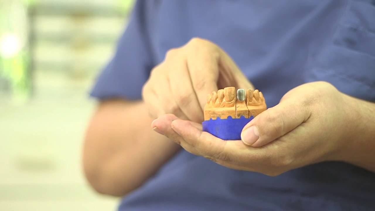 Dental Crowns