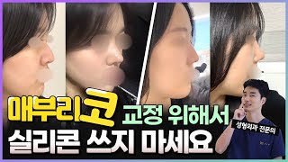 매부리코 교정은 무보형물로 하세요