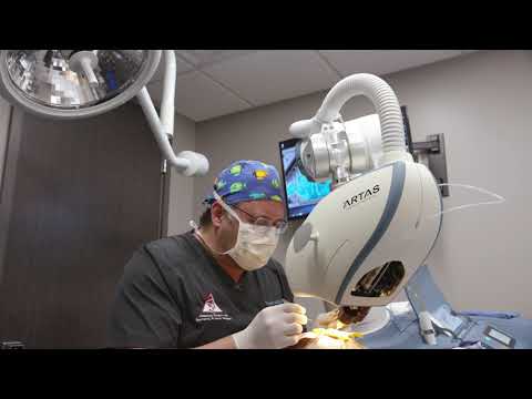 Hair Transplant on Local Celebrity Phil Bourque