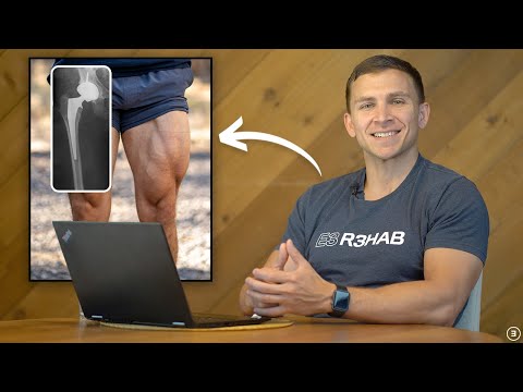 Doctor of Physical Therapy Answers Your 10 Most Common Questions About Total Hip Replacements