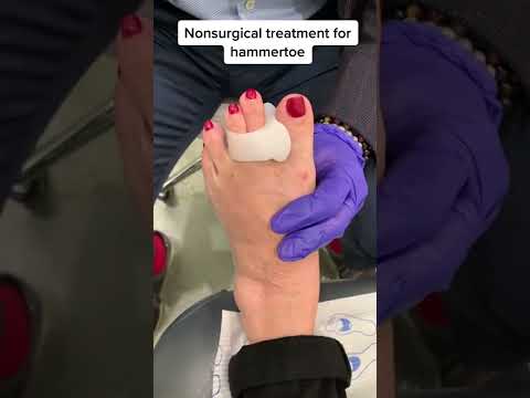 Hammertoe fix