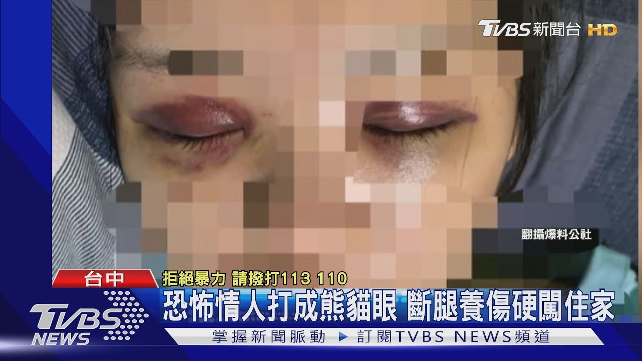 恐怖情人打成熊貓眼 斷腿養傷硬闖住家