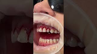 This technique is known as a gum lift, gum contouring or gum augmentation ✨