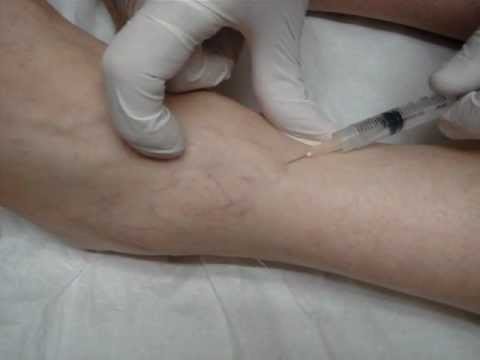 Încărcarea piciorului după operație varico