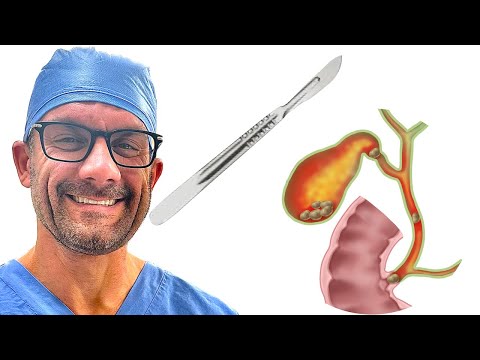 Treating Acute Cholecystitis with a Surgeon
