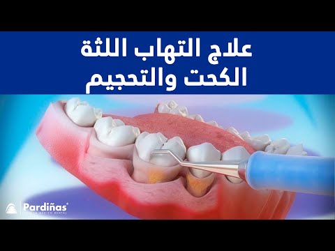 15/08/2022 12:00:00 ص
علاج التهاب اللثة - الكحت والتحجيم ©,,.. https://www.youtube.com/embed/iqfWsCsp-pU