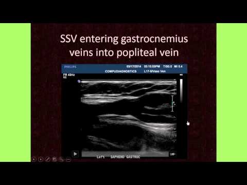 The Importance of Venous Anatomy for the Reflux Ultrasound Examination